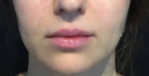 Before Image: Lip Augmentation