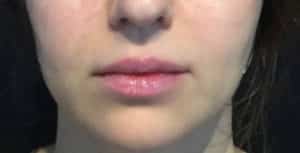 Lip Augmentation