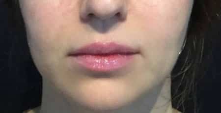 Before Image: Lip Augmentation - front