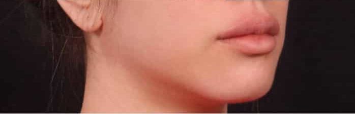 After Image: Lip Augmentation - right-front-oblique