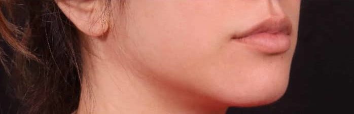 Before Image: Lip Augmentation - right-front-oblique
