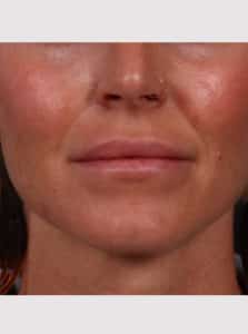 After Image: Lip Augmentation
