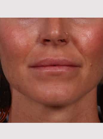 After Image: Lip Augmentation - front