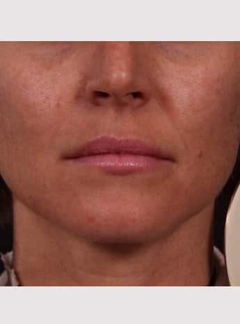 Before Image: Lip Augmentation - front