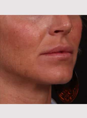 After Image: Lip Augmentation - right-front-oblique