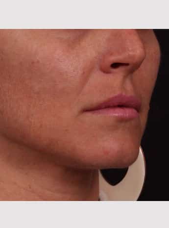 Before Image: Lip Augmentation - right-front-oblique