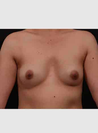 Before Image: Breast Augmentation - front