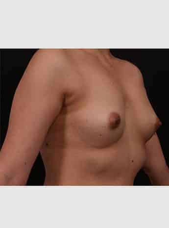 Before Image: Breast Augmentation - right-front-oblique