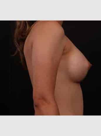 After Image: Breast Augmentation - right-side