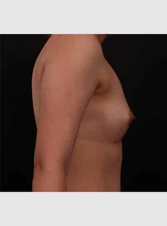 Before Image: Breast Augmentation - right-side