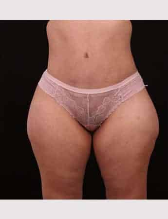 After Image: Tummy Tuck (Abdominoplasty) - front