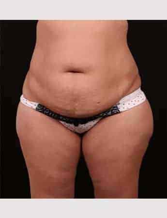 Before Image: Tummy Tuck (Abdominoplasty) - front