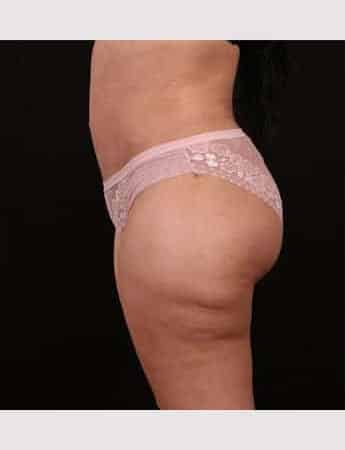 After Image: Tummy Tuck (Abdominoplasty) - left-side