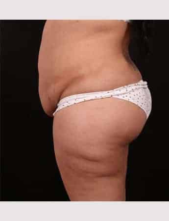 Before Image: Tummy Tuck (Abdominoplasty) - left-side