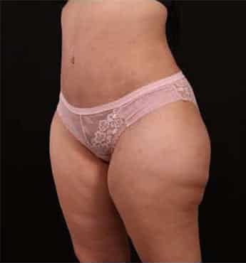 After Image: Tummy Tuck (Abdominoplasty) - left-front-oblique