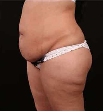 Before Image: Tummy Tuck (Abdominoplasty) - left-front-oblique