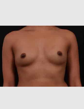Before Image: Breast Augmentation - front