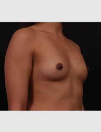 Before Image: Breast Augmentation - right-front-oblique