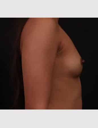 Before Image: Breast Augmentation - right-side