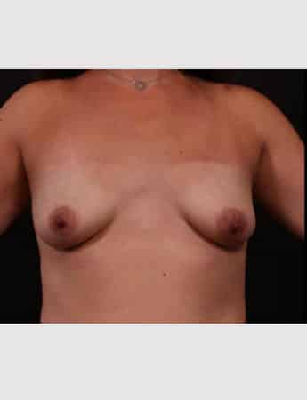 Before Image: Breast Lift (Mastopexy) with Augmentation - front
