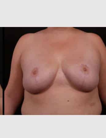 After Image: Breast Reduction - front