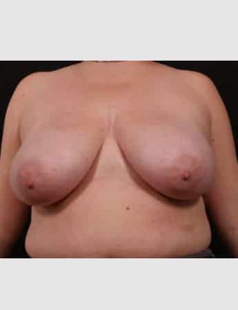 Before Image: Breast Reduction - front