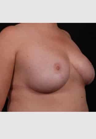 After Image: Breast Reduction - right-front-oblique