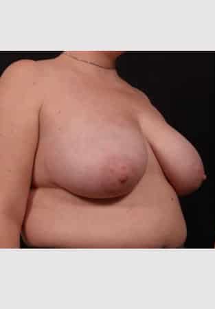 Before Image: Breast Reduction - right-front-oblique