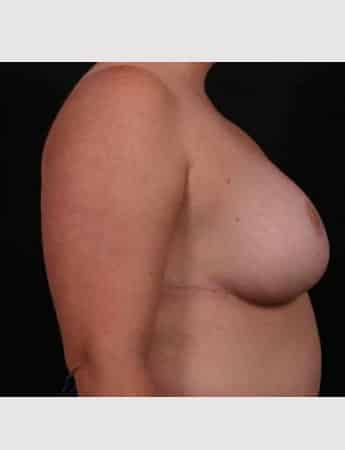 After Image: Breast Reduction - right-side