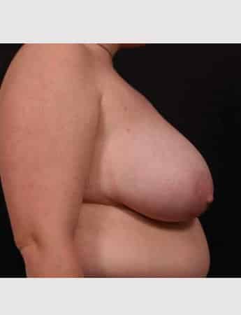 Before Image: Breast Reduction - right-side
