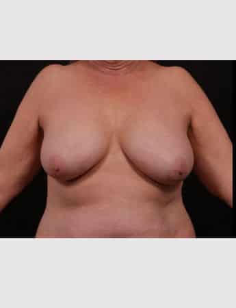 Before Image: Mastopexy (Breast Lift) - front