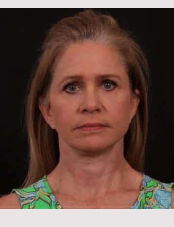 After Image: Neck Lift / Lower Facelift - front