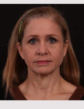 Before Image: Neck Lift / Lower Facelift - front