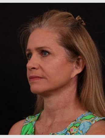 After Image: Neck Lift / Lower Facelift - left-front-oblique