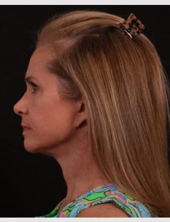 After Image: Neck Lift / Lower Facelift - left-side