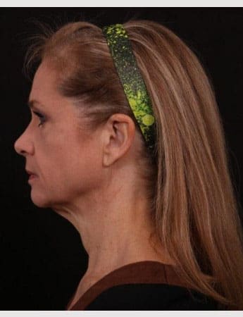 Before Image: Neck Lift / Lower Facelift - left-side