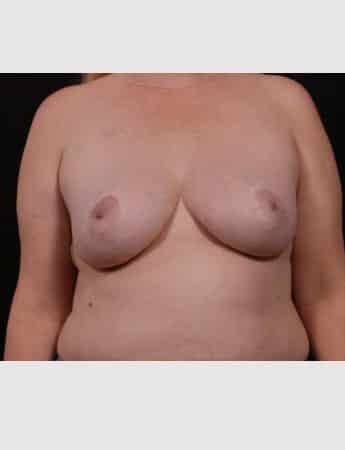 After Image: Secondary Breast Surgery - front