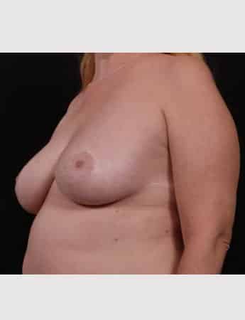 After Image: Secondary Breast Surgery - left-front-oblique