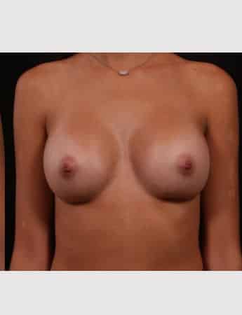 After Image: Breast Augmentation - front