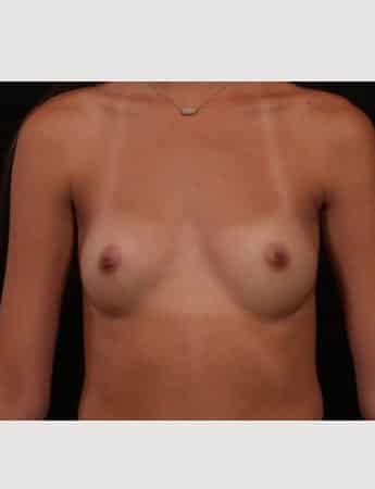 Before Image: Breast Augmentation - front