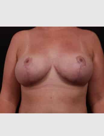 After Image: Breast Reduction - front