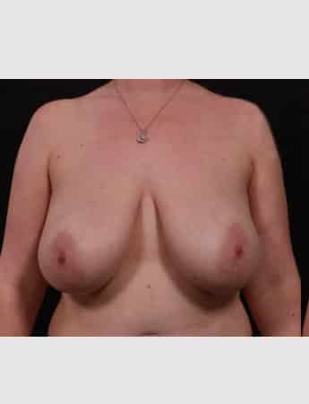 Before Image: Breast Reduction - front