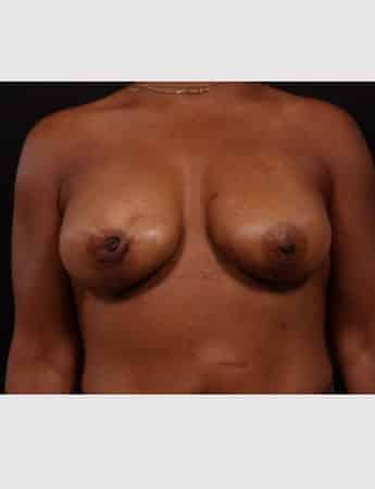 After Image: Secondary Breast Surgery - front