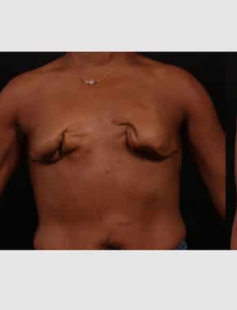 Before Image: Secondary Breast Surgery - front