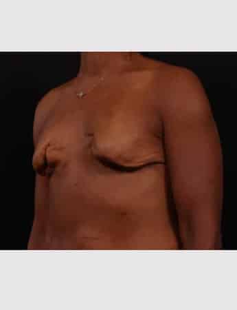 Before Image: Secondary Breast Surgery - left-front-oblique