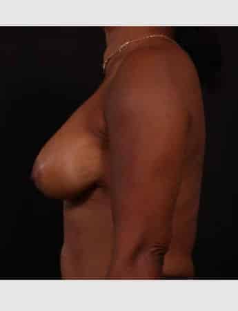 After Image: Secondary Breast Surgery - left-side