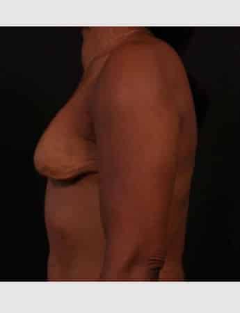 Before Image: Secondary Breast Surgery - left-side