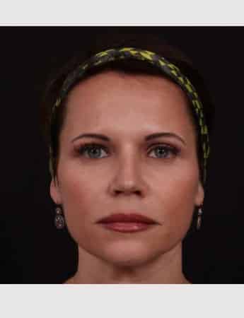 After Image: Revision Rhinoplasty - front