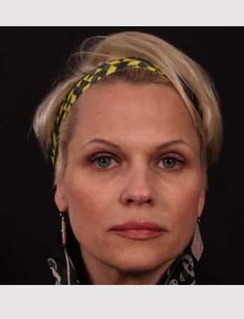 Before Image: Revision Rhinoplasty - front
