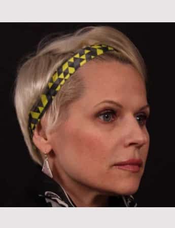 Before Image: Revision Rhinoplasty - right-front-oblique